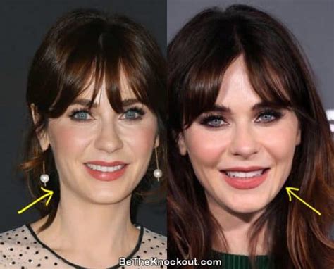 zooey deschanel filler|Zooey Deschanel Plastic Surgery Before & After